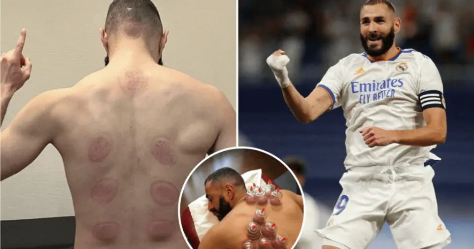 Atheletes Hijama