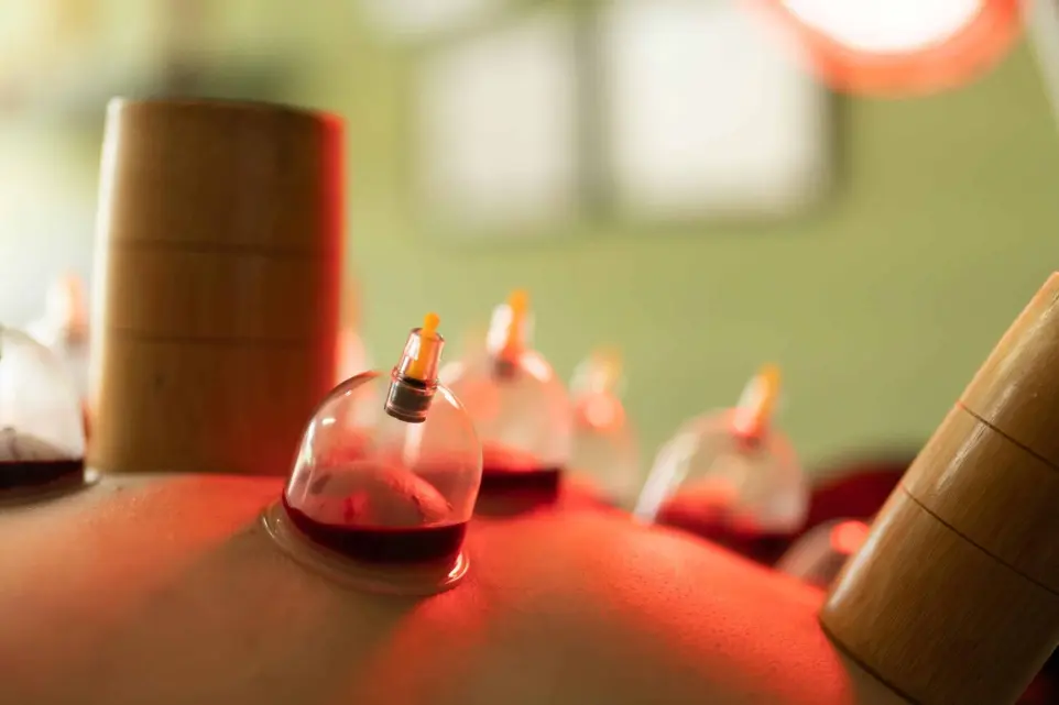 Hijama Cupping Therapy