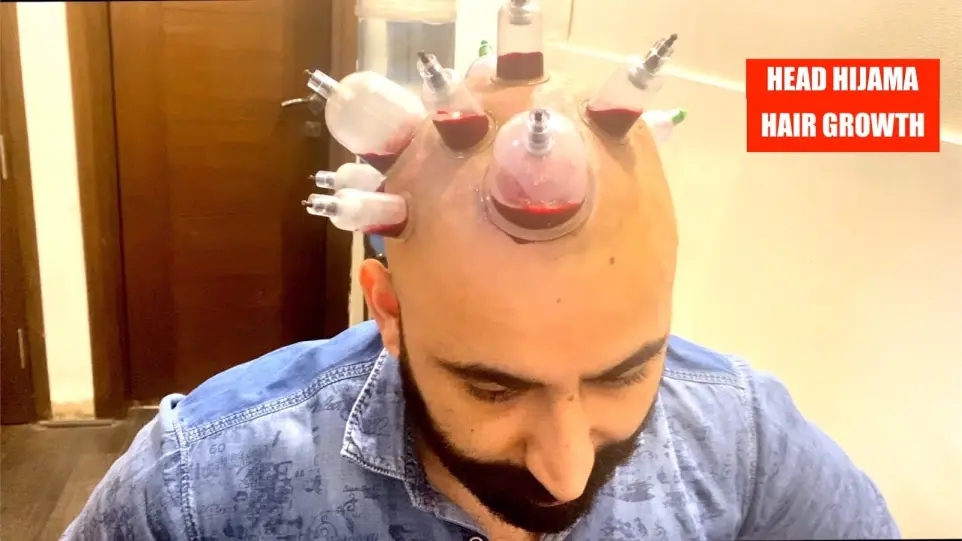 Head Hijama